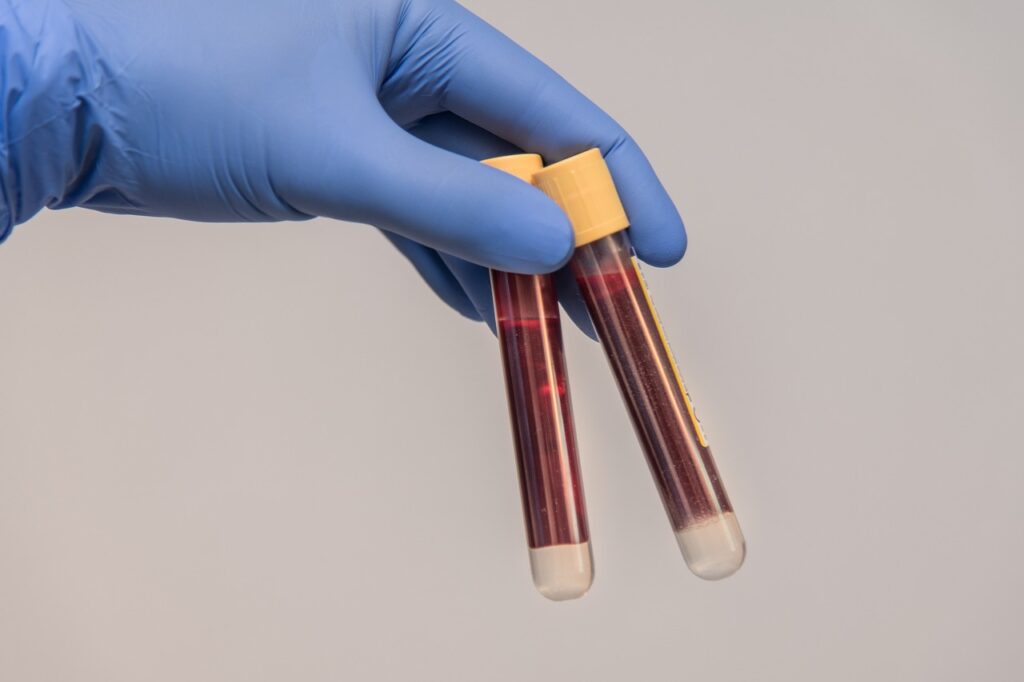 PRP plasma rico en plaquetas iniflóntracion cadiz jerez